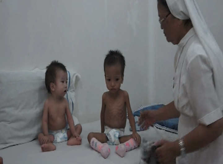 3 Bocah Bersaudara Asal Nias Barat Menderita Gizi Buruk