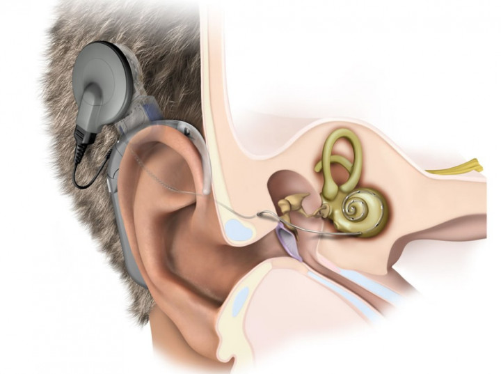 Mengenal Metode Implan Koklea untuk Atasi Gangguan Pendengaran
