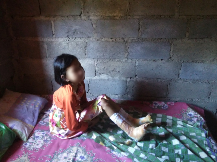 Berawal dari Flek di Pipi, Bocah Ini Lumpuh 2 Bulan