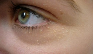 Benjolan Kecil di Kantung Mata Mengindikasikan Kolesterol