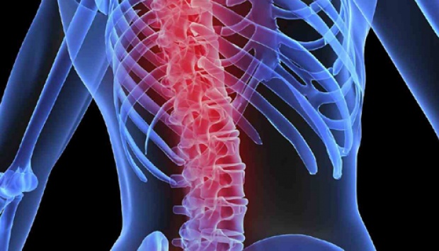 Kapan Penderita Skoliosis Harus Operasi?