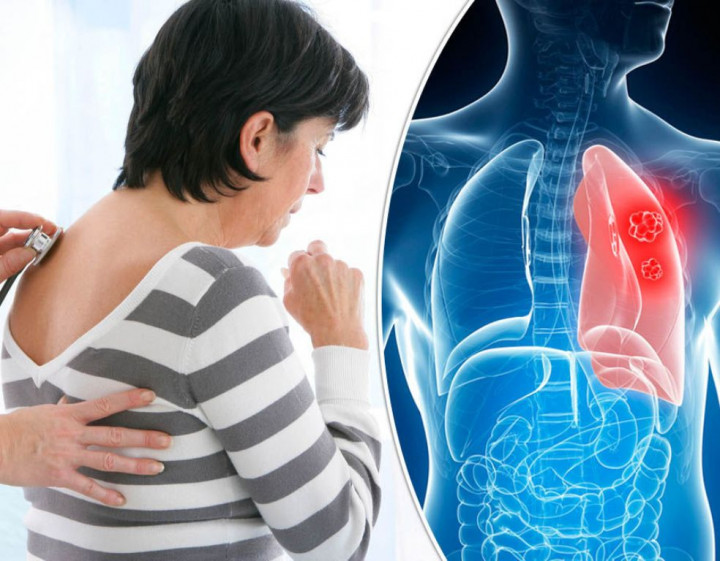 Persentase Kanker Paru Terus Meningkat Tiap Tahun