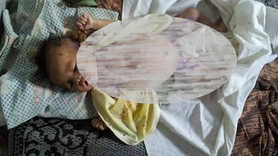 Bayi Penderita Sepsis di RS Adam Malik tak Punya BPJS