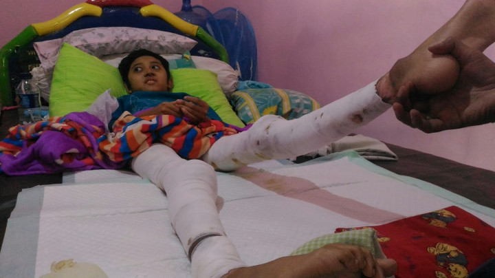 Dua Kaki Helmi Hangus Tersambar Api Unggun Pramuka