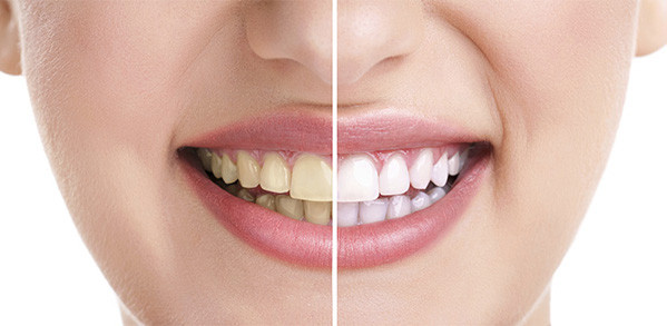 6 Penyebab Noda pada Gigi