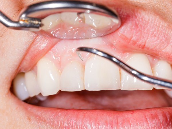 Gejala Kanker Kerongkongan yang Sering Dianggap Remeh