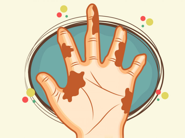 Hari ini: Mikroba Penyebab Lepra Ditemukan