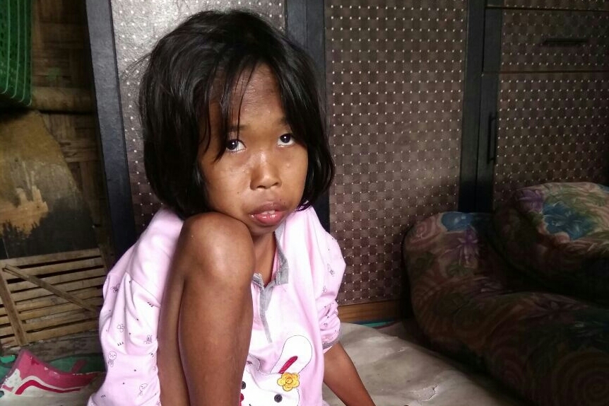  Mahesa, 13, yang mengidap gizi buruk di Kronjo, Kabupaten Tangerang. Foto: Medcom.id/Hendrik Simorangkir