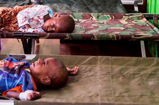 Penyebab Gizi Buruk di Kota Besar