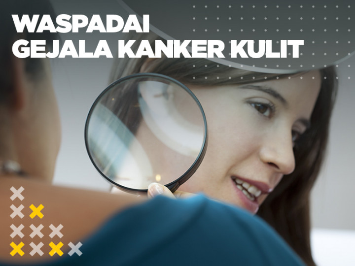 FYI: Waspadai  Gejala Kanker Kulit