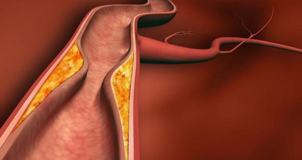 Kolesterol Jahat yang Tinggi Pengaruhi Kesuburan Wanita