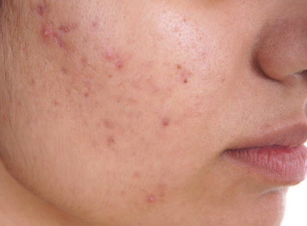 (Foto: Medicalnewstoday)