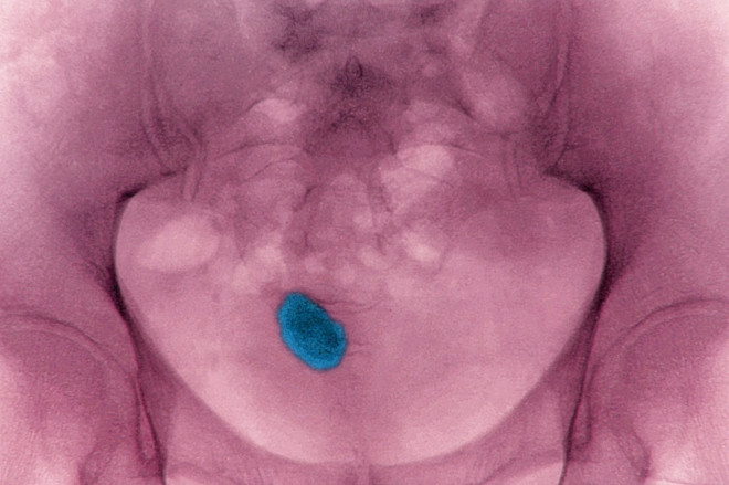 Ilustrasi penderita batu ginjal. (BSIP via Getty Images)