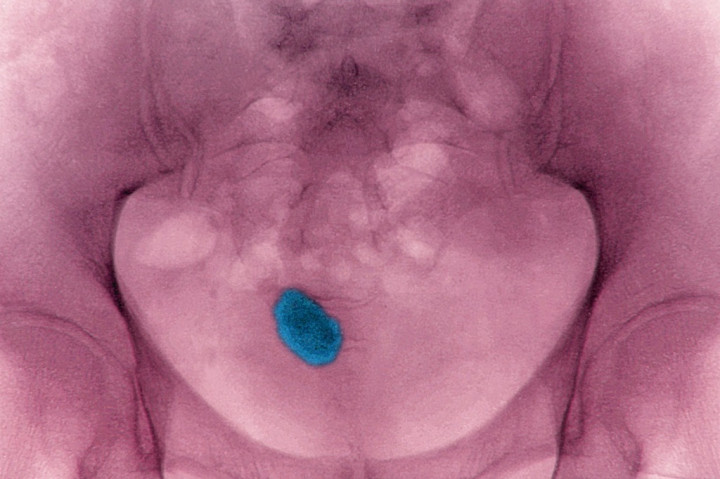 Kalkulator Online Ini Bisa Prediksi Batu Ginjal