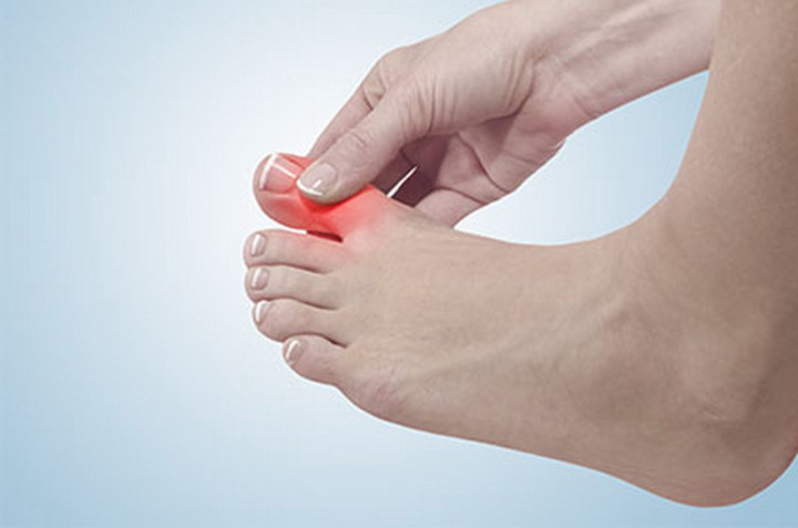 Cara Alami Mengobati Asam Urat