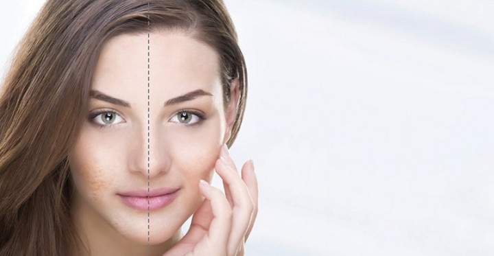 Jerawat Membesar, Begini Cara Mengatasinya