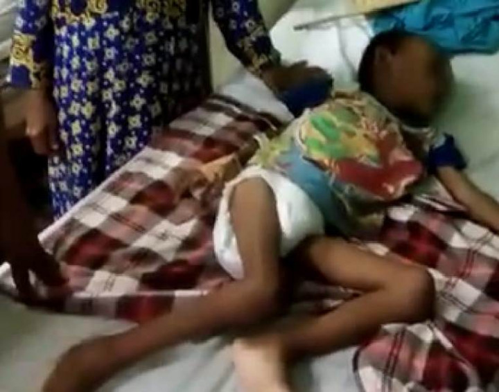 Bocah 7 Tahun di Karawang Menderita Gizi Buruk