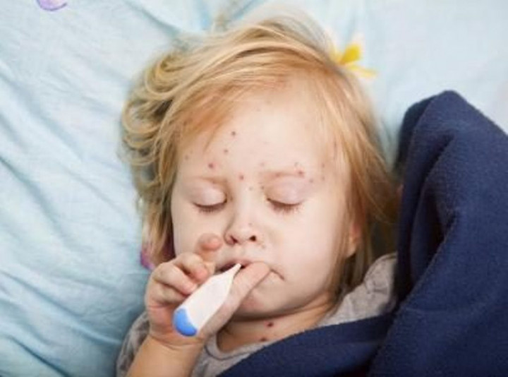 Risiko Campak pada Anak Mirip dengan HIV