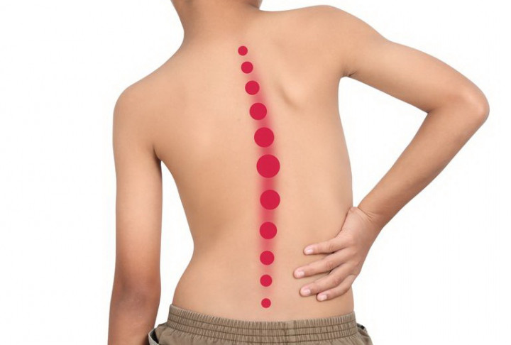 Penyebab dan Cara Pengobatan Skoliosis