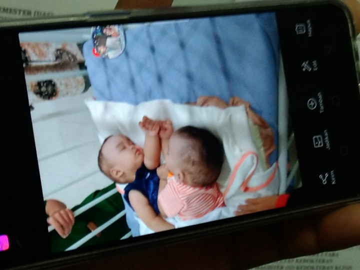 Bayi Kembar Siam Adam-Malik Berhasil Dipisahkan