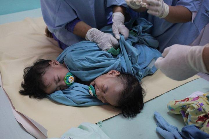 Kembar Siam Aqila dan Azila Jalani Operasi Pemisahan