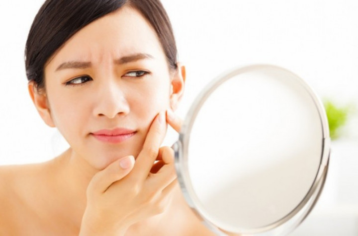 Bekas Jerawat Masih jadi Masalah yang Sering Dialami Wanita