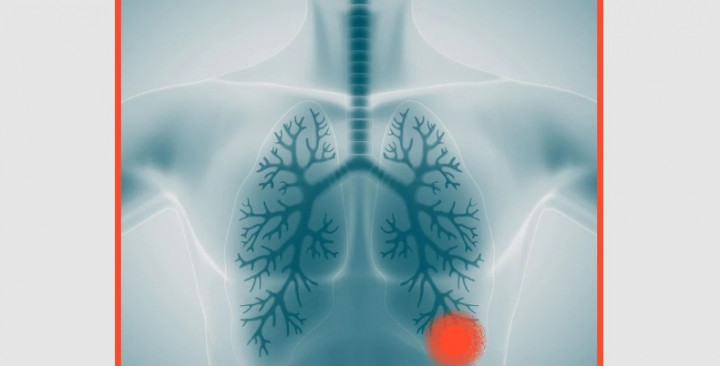 Mengenal Legionnaires, Wabah yang Menelan Satu Nyawa di AS