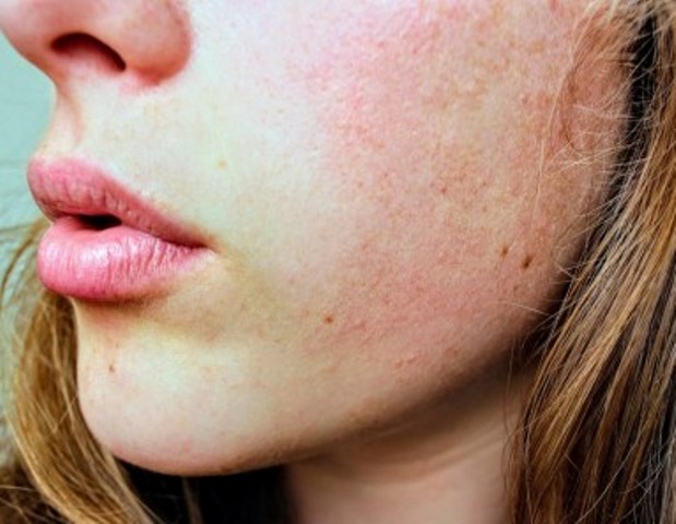 Apakah Stres bisa Menyebabkan Jerawat?