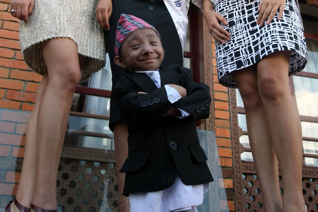 Pria Terpendek Dunia Meninggal di Usia 27 Tahun