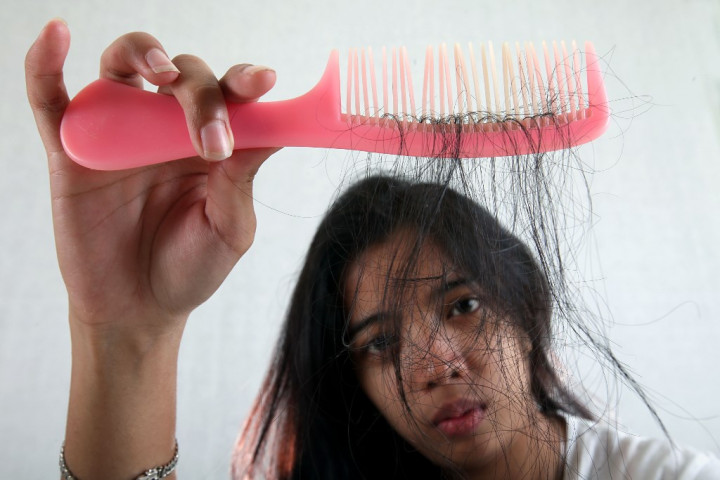 Stres Bisa Mengakibatkan Penyakit Alopecia