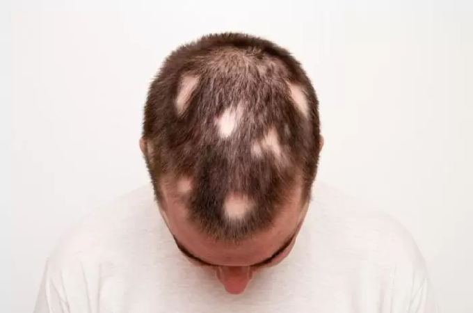 Seperti halnya penyakit lain, jika dibiarkan terus-menerus, alopecia akan memperburuk kondisi pengidapnya. (Foto: Dok. Medicalnewstoday.com)