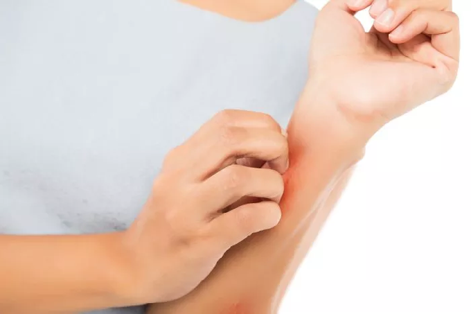 Trik Jitu Atasi Gatal Akibat Gigitan Nyamuk