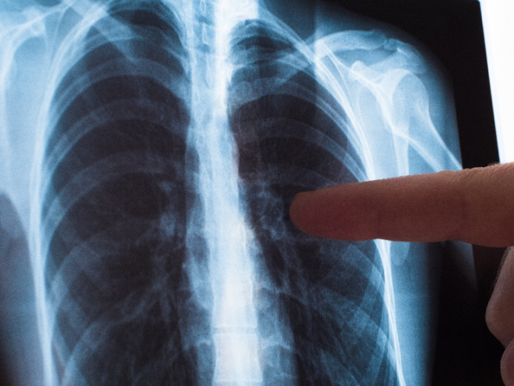 Penderita TBC di Jateng Capai 23.919 Jiwa