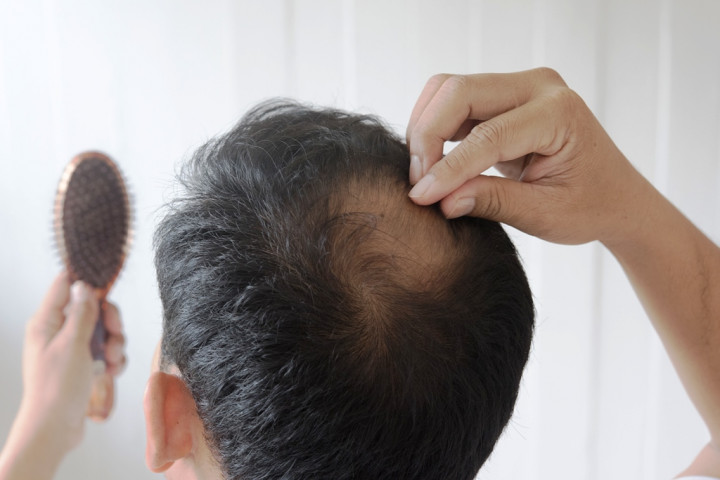 Hubungan antara Covid-19 dengan Kerontokan Rambut