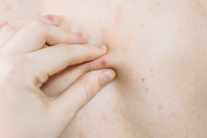 Penyebab Terjadinya Jerawat di Punggung