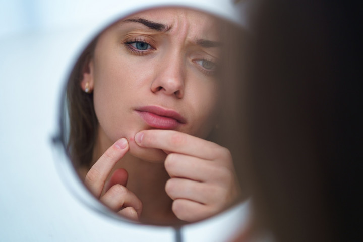 Menghilangkan Jerawat dengan Minyak Pohon Teh