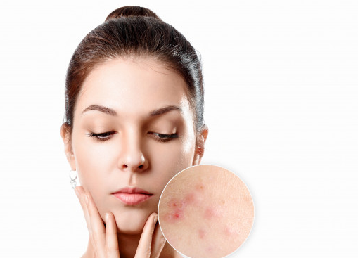 Jika kamu berjerawat, kemungkinan besar kamu memiliki jerawat vulgaris, yang bisa muncul di wajah, punggung, bahu, dan bokong. (Foto: Ilustrasi. Dok. Freepik.com)