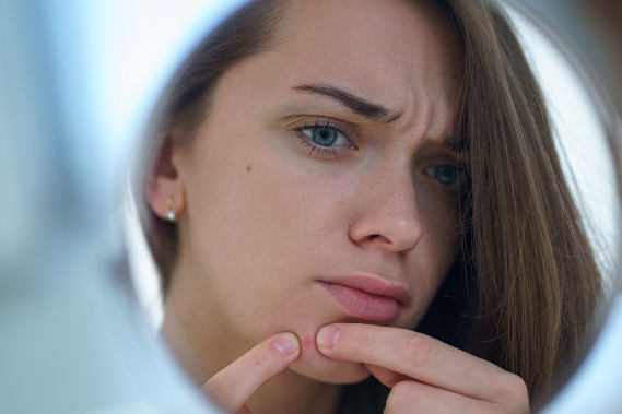 Mengenal Maskne, Jerawat yang Muncul Akibat Penggunaan Masker