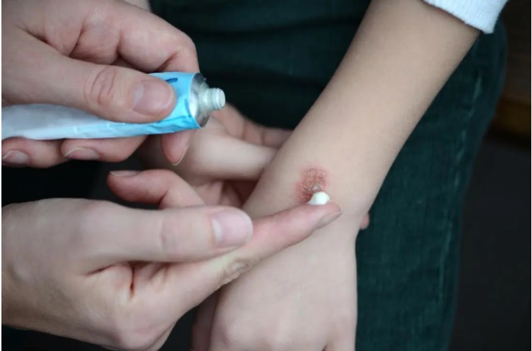 Luka bakar harus diberikan perawatan yang maksimal agar tak meninggalkan bekas (Foto: Medical News Today)