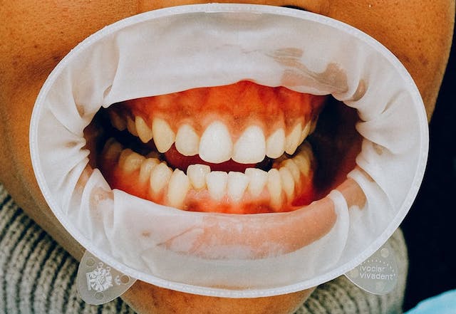 Jika sariawan dibiarkan dan tidak ditangani dengan baik, peradangan tersebut bisa membahayakan bahkan bisa berujung pada kanker mulut. (Ilustrasi/Pexels)