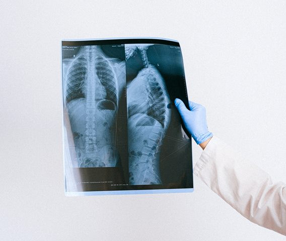 Penelitian menemukan masih ditemukan perbedaan besar dalam paru-paru pasien covid-19 bahkan setelah tiga bulan setelah pasien terinfeksi. (Foto: Ilustrasi/Pexels.com)
