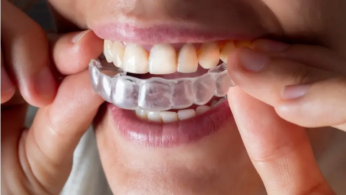 Manakah yang Lebih Efektif, Invisalign atau Kawat Gigi Tradisional?
