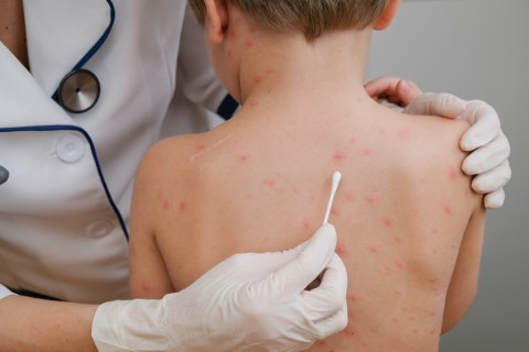 Cara Penularan Herpes Zoster serta Pencegahannya