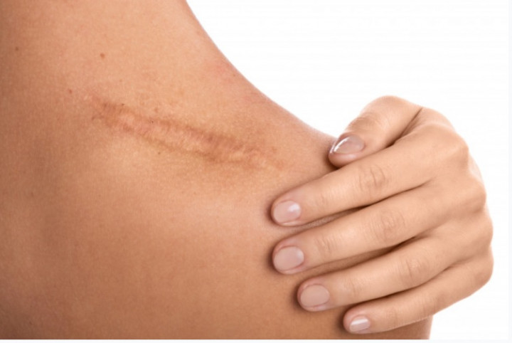 Koreng Terasa Gatal! Jangan Tergoda untuk Menggaruk, Ini Akibatnya