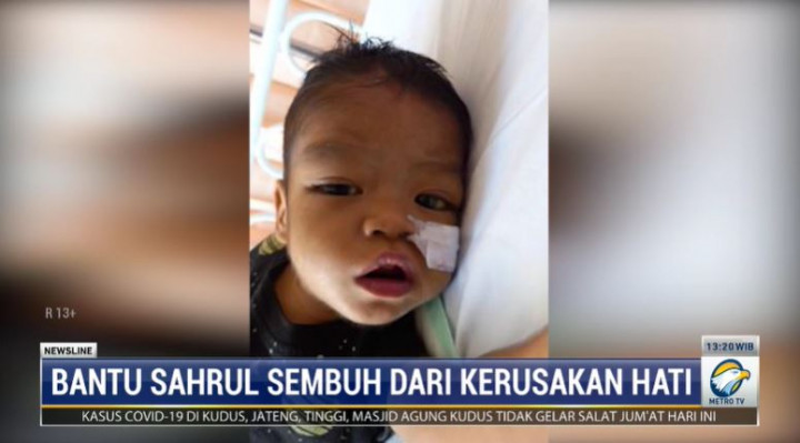 Sahrul, Balita Pengidap Atresia Bilier Butuh Donasi