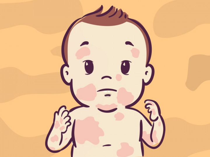 9 Cara Mencegah Ruam pada Kulit Bayi Baru Lahir