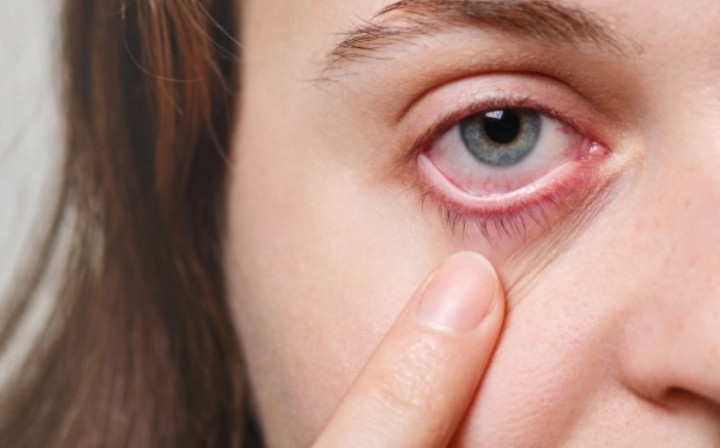 8 Kelainan Mata yang Muncul akibat Lepra