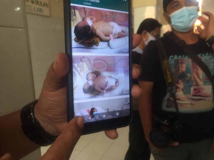 Bayi Berkepala Dua di Tegal Meninggal
