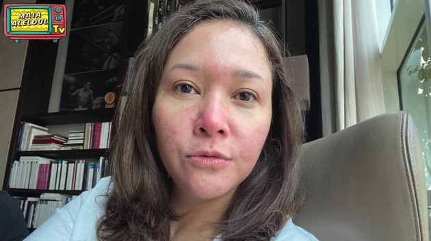 Mengenal Rosacea, Penyakit Kulit yang Diderita Maia Estianty