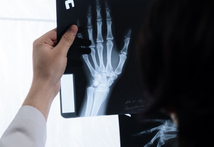 Wapres Dukung Gerakan Nasional Melawan Osteoporosis